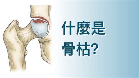 骨枯手術費用|【髖關節手術】即睇原理、副作用及詳細步驟+收費參。